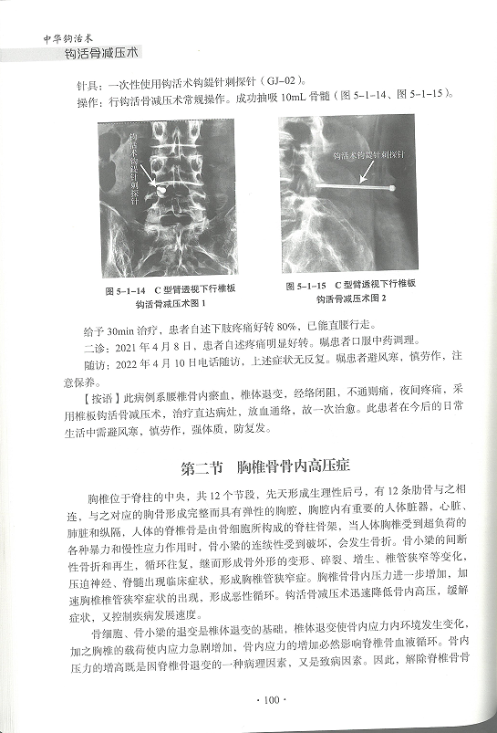 中华钩活术钩活骨减压术（脊柱关节骨疾病第二节）